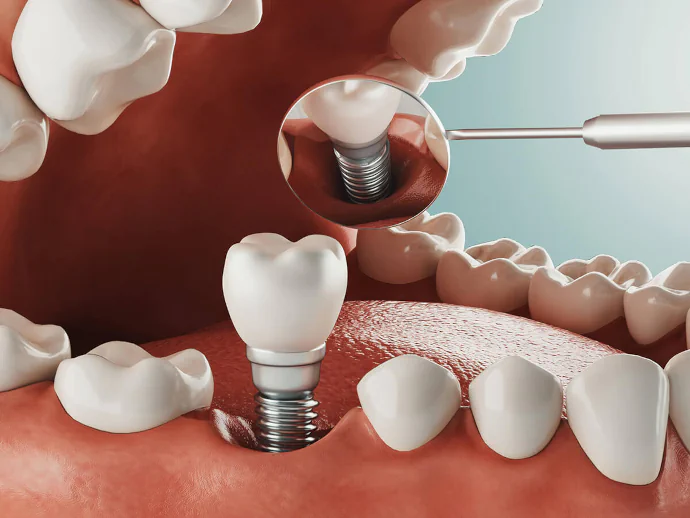 Dental Implants in Acton, MA at Acton Family Dentists