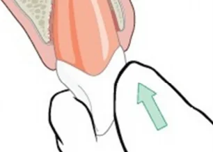 How to treat an avulsed tooth